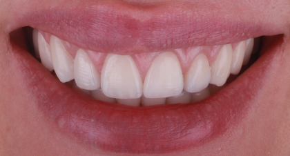 Vorher-Nachher-Bild | Gummy Smilevon Dr. med. dent. Soeren Pinz, M.Sc. | Krefeld ef575e88 Nachher-Bild