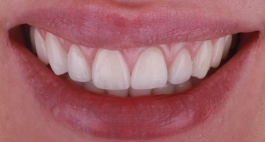 Behandlung Vorher-Nachher-Bild | Gummy Smilevon Dr. med. dent. Soeren Pinz, M.Sc. | Krefeld ef575e88 Vorher-Bild