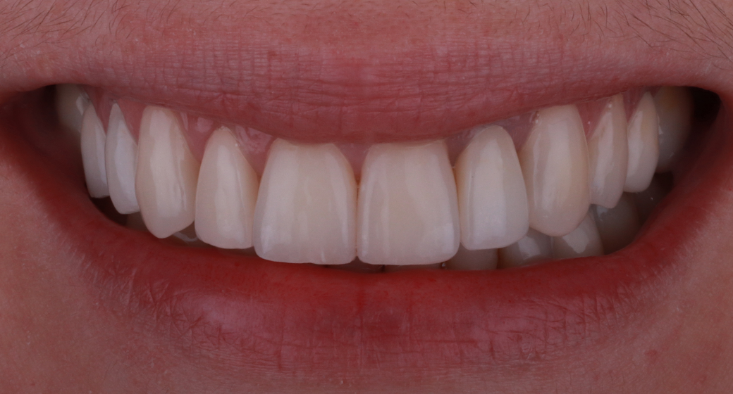Behandlung Vorher-Nachher-Bild | Kronenvon Dr. med. dent. Soeren Pinz, M.Sc. | Krefeld ef575e88 Vorher-Bild
