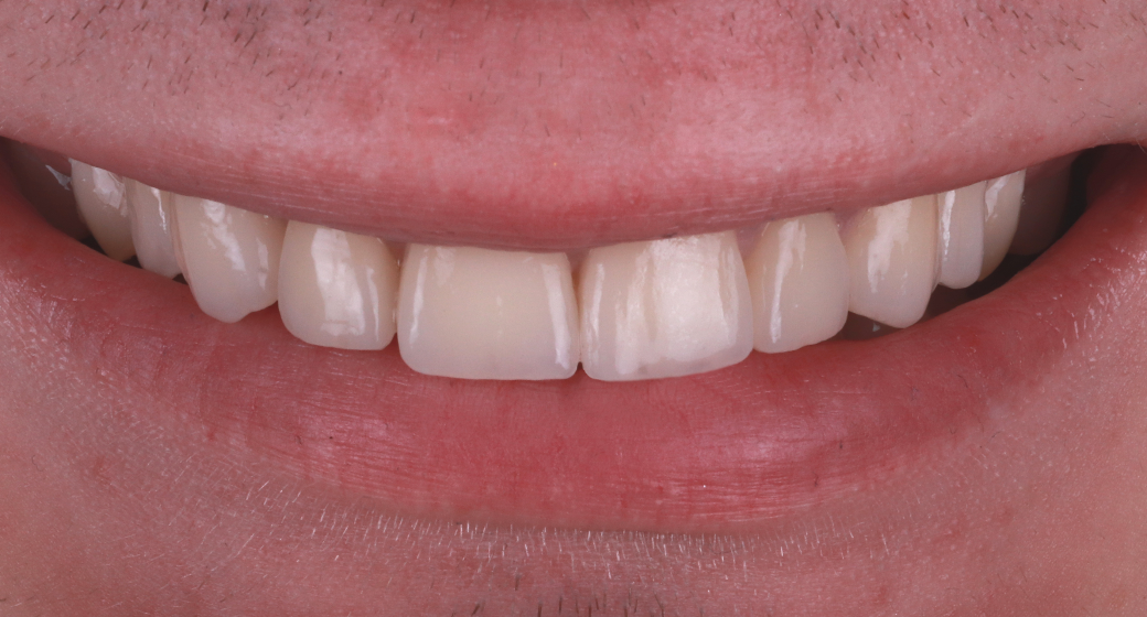 Behandlung Vorher-Nachher-Bild | Veneersvon Dr. med. dent. Soeren Pinz, M.Sc. | Krefeld ef575e88 Vorher-Bild