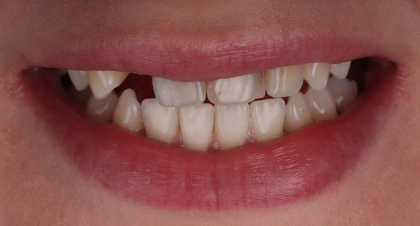 Vorher-Nachher-Bild | Implantatevon Dr. med. dent. Soeren Pinz, M.Sc. | Krefeld ef575e88 Vorher-Bild