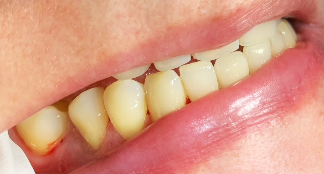 Behandlung Vorher-Nachher-Bild | Füllung, Parodontologie  | von ZÄ Nasibeh Rad | Niederkassel f457c545 Vorher-Bild