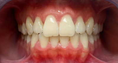 Vorher-Nachher-Bild | Parodontologie  | von ZA Nasibeh  Rad  | Niederkassel f457c545 Nachher-Bild