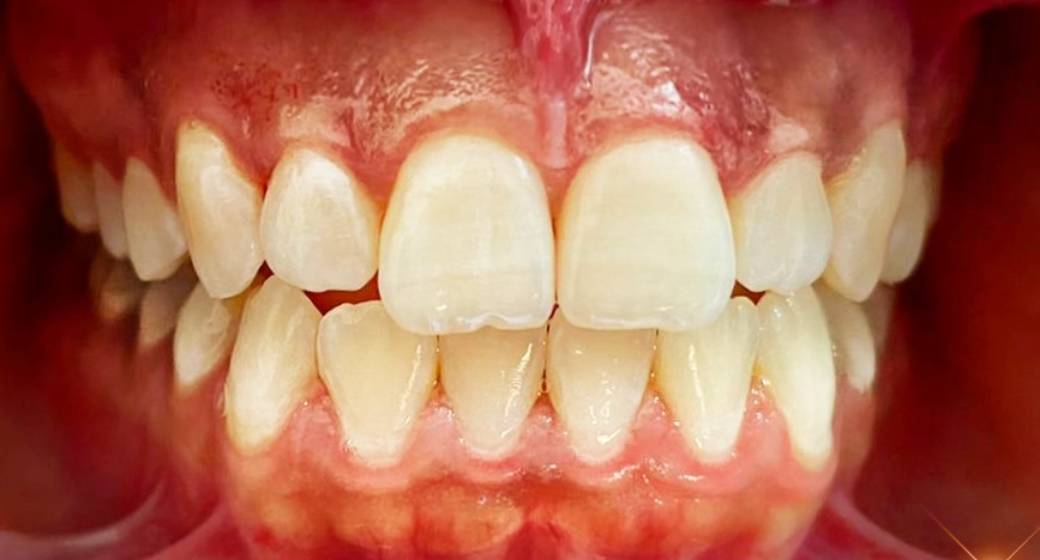 Behandlung Vorher-Nachher-Bild | Parodontologie  | von ZA Nasibeh  Rad  | Niederkassel f457c545 Nachher-Bild