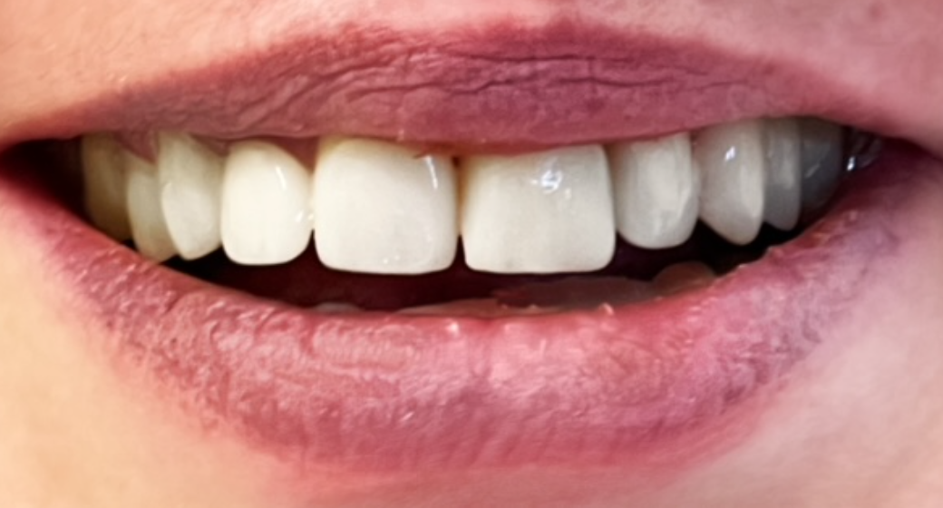 Behandlung Vorher-Nachher-Bild | Implantate, Kronen, Parodontologie  | von ZA Nasibeh  Rad  | Niederkassel f457c545 Vorher-Bild