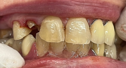 Vorher-Nachher-Bild | Implantate, Kronen, Parodontologie  | von ZA Nasibeh  Rad  | Niederkassel f457c545 Vorher-Bild
