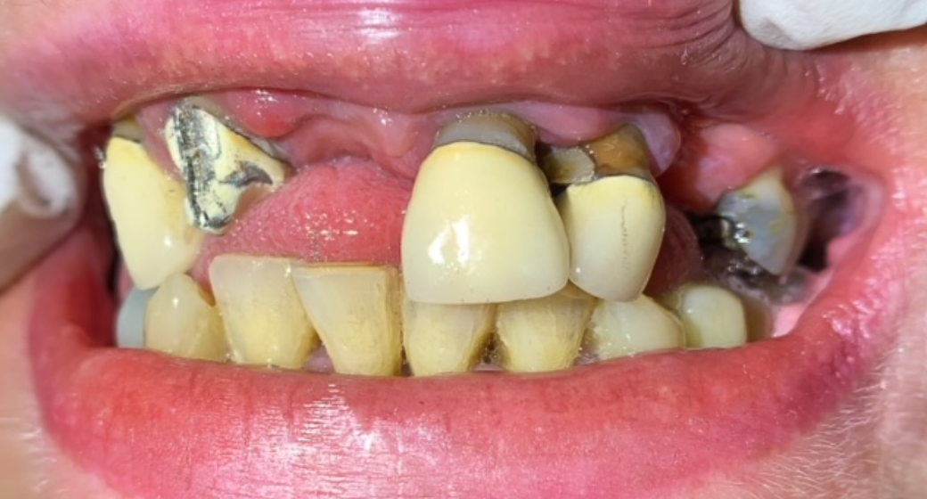 Vorher-Nachher-Bild | Brücken, Implantate, Kronen, Parodontologie | von | Niederkassel f457c545 Vorher-Bild