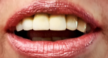 Vorher-Nachher-Bild | Brücken, Implantate, Kronen, Parodontologie | von | Niederkassel f457c545 Nachher-Bild